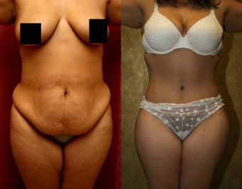 tummy tuck or abdominoplasty with liposuction before 948689