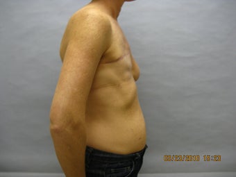 48 year old woman with breast reconstruction 1016314