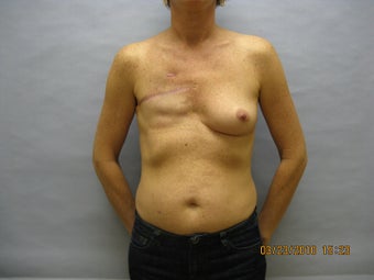 48 year old woman with breast reconstruction before 1016314