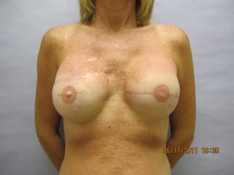 48 year old woman with breast reconstruction after 1016314