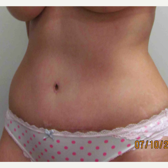 Tummy Tuck for this 43 Year Old Woman after 3092415