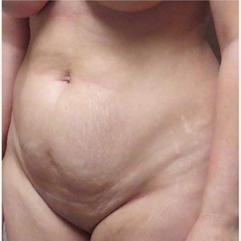 Tummy Tuck for this 43 Year Old Woman before 3092415