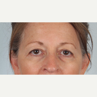 55-64 year old woman treated with upper and lower eyelid surgery and eye bag removal before 3520401