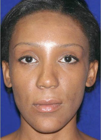 Ethnic Rhinoplasty after 312665