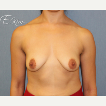 25-34 year old woman treated with Breast Lift before 3663368