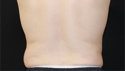one sided coolsculpting treatment of hips 1204029