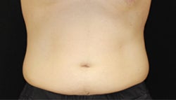 one sided coolsculpting treatment of hips before 1204029