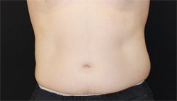 one sided coolsculpting treatment of hips after 1204029