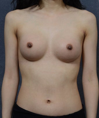 26 Year Old Female with Breast Augmentation after 1472757