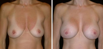 40 year old female, breast augmentation before 628408