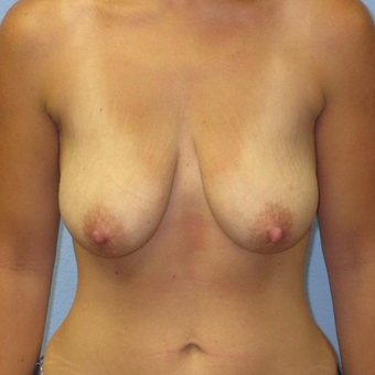 25-34 year old woman treated with Breast Augmentation before 3400553