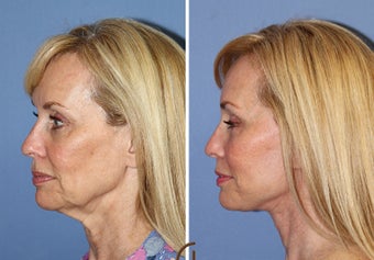 Lower Face and Neck Lift without General Anesthesia 1344081