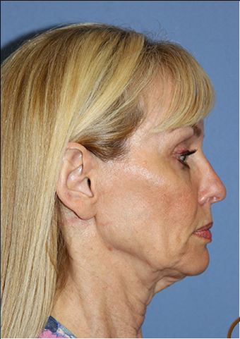 Lower Face and Neck Lift without General Anesthesia before 1344081