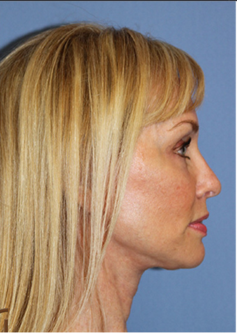 Lower Face and Neck Lift without General Anesthesia after 1344081