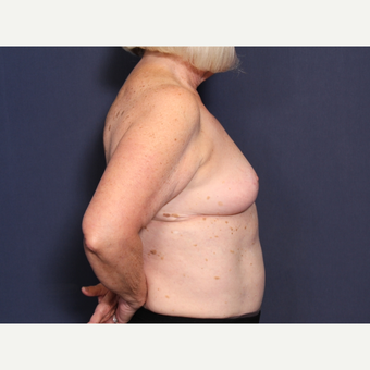 65-74 year old woman treated with Breast Reduction (view 2 of 2) after 3566215
