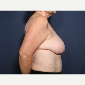65-74 year old woman treated with Breast Reduction (view 2 of 2) before 3566215