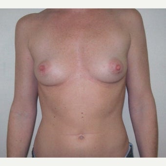 42 year old woman treated with Breast Augmentation before 1981528