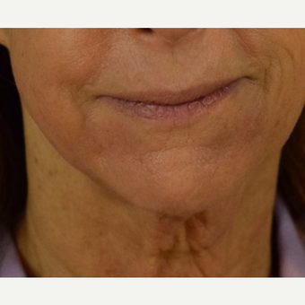 Before and after HALO Laser for Perioral Lines after 3169609