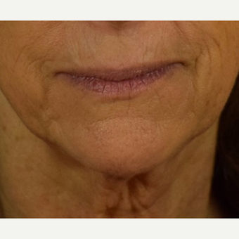 Before and after HALO Laser for Perioral Lines before 3169609