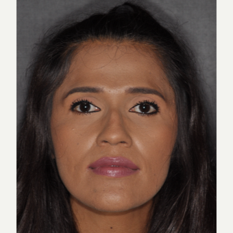 25-34 year old woman treated with Nose Surgery 10 days post-op before 3452313
