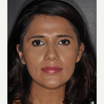 25-34 year old woman treated with Nose Surgery 10 days post-op after 3452313