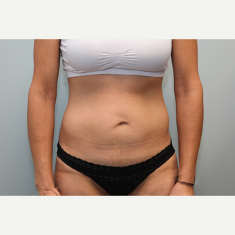 25-34 year old woman treated with Mini Tummy Tuck before 3797339