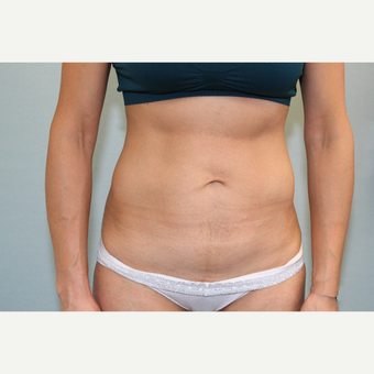 25-34 year old woman treated with Mini Tummy Tuck after 3797339