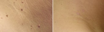 Mole Removal before 1212000