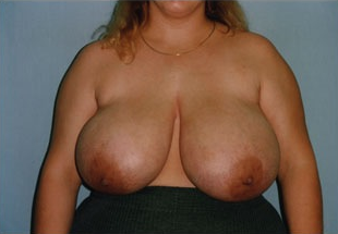 Breast Reduction before 1409089