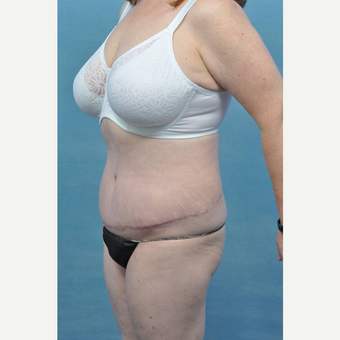 45-54 year old woman treated with Tummy Tuck after 3489510