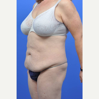 45-54 year old woman treated with Tummy Tuck before 3489510