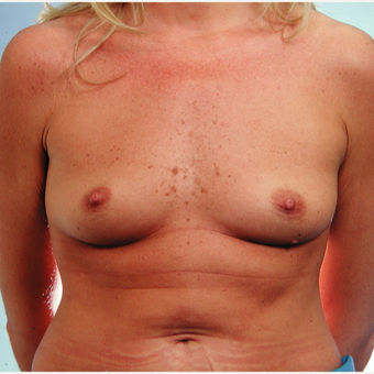 25-34 year old woman treated with Breast Implants before 3429591
