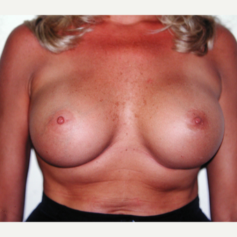 25-34 year old woman treated with Breast Implants after 3429591