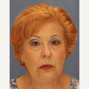65-74 year old woman treated with Lower Eyelid Surgery before 3065073