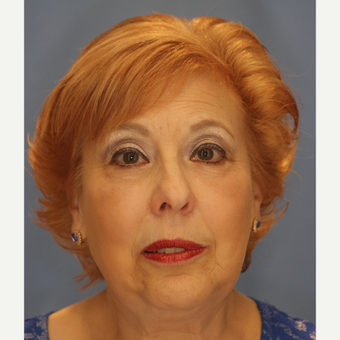 65-74 year old woman treated with Lower Eyelid Surgery after 3065073