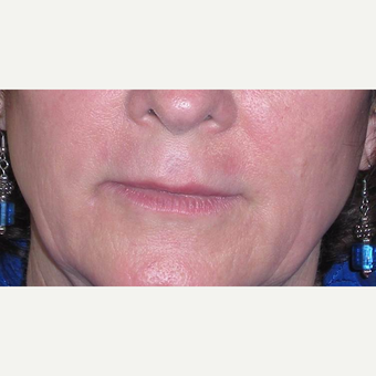 55-64 year old woman treated with Restylane after 3372448