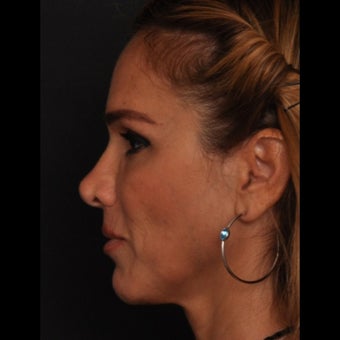 45-54 year old woman treated for Revision Rhinoplasty 1533378