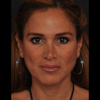 45-54 year old woman treated for Revision Rhinoplasty before 1533378