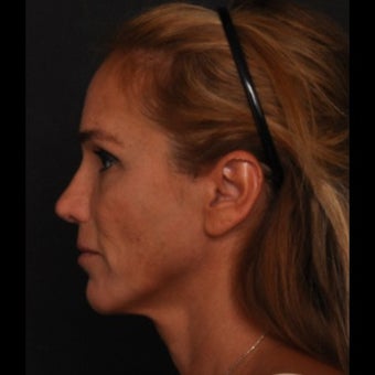 45-54 year old woman treated for Revision Rhinoplasty 1533378