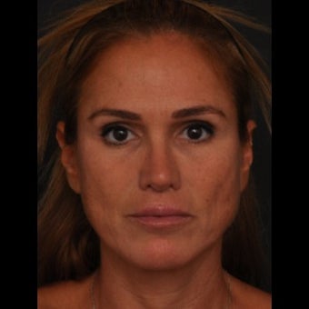 45-54 year old woman treated for Revision Rhinoplasty after 1533378