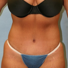 35-44 year old woman treated with Tummy Tuck after 1679407