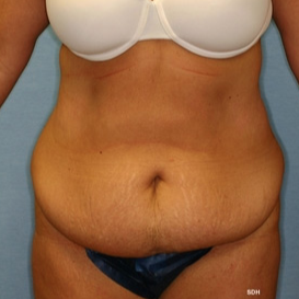 35-44 year old woman treated with Tummy Tuck before 1679407