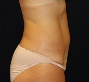 Tummy Tuck 939990