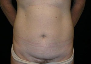 Tummy Tuck before 939990