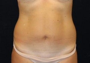 Tummy Tuck after 939990