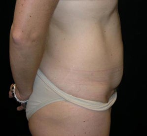 Tummy Tuck 939990