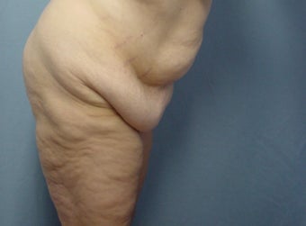 45 year old Tummy tuck after weight loss 65# 923718