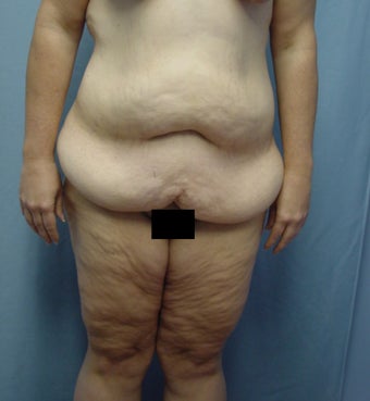 45 year old Tummy tuck after weight loss 65# before 923718