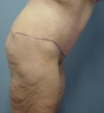 45 year old Tummy tuck after weight loss 65# 923718