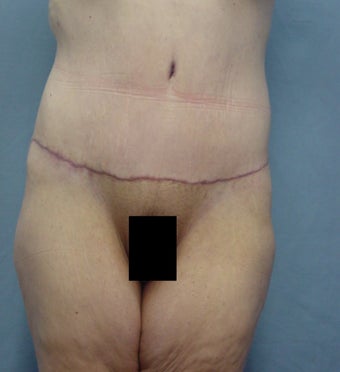 45 year old Tummy tuck after weight loss 65# after 923718